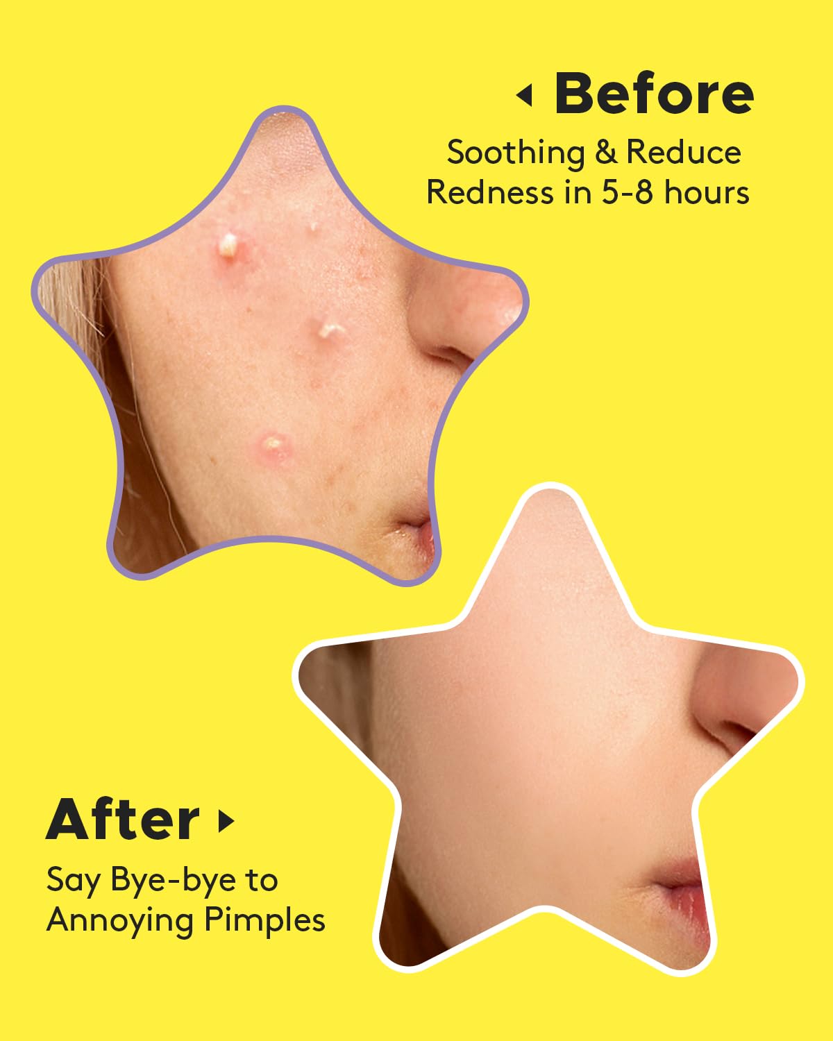LitBear Acne Patch Pimple Patch, Black Star & Heart Shaped Acne Absorbing Cover Patch, Hydrocolloid Acne Patches For Face Zit Patch Pimple Sticker Acne Dots, Tea Tree Oil + Centella (108 Count)