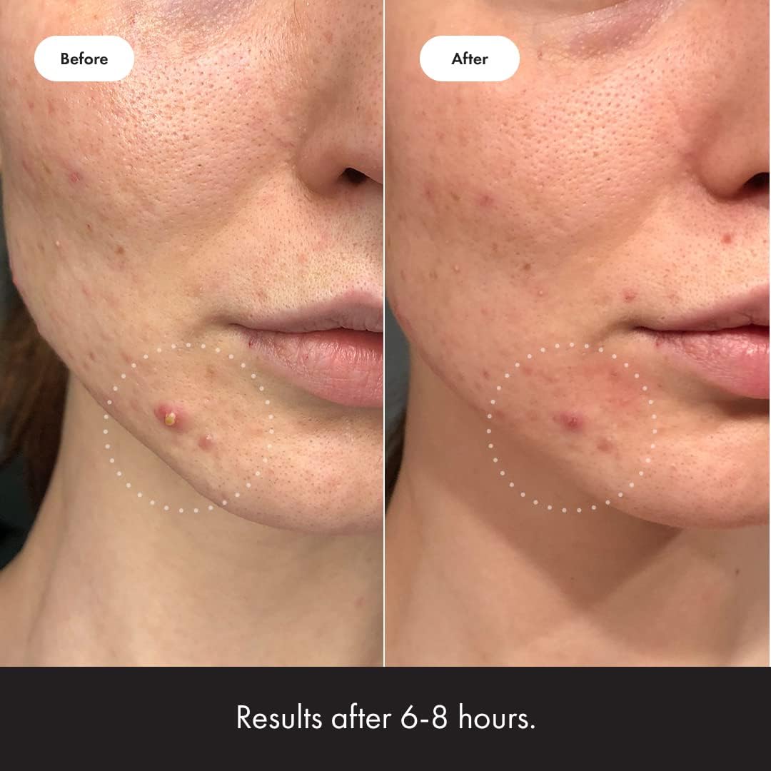 Mighty Patch™ Invisible+ Patch – The Barely-There Daytime Hydrocolloid Acne Pimple Patch for Covering Zits and Blemishes, Tapered Edges Designed to Blend Into Skin (72ct)