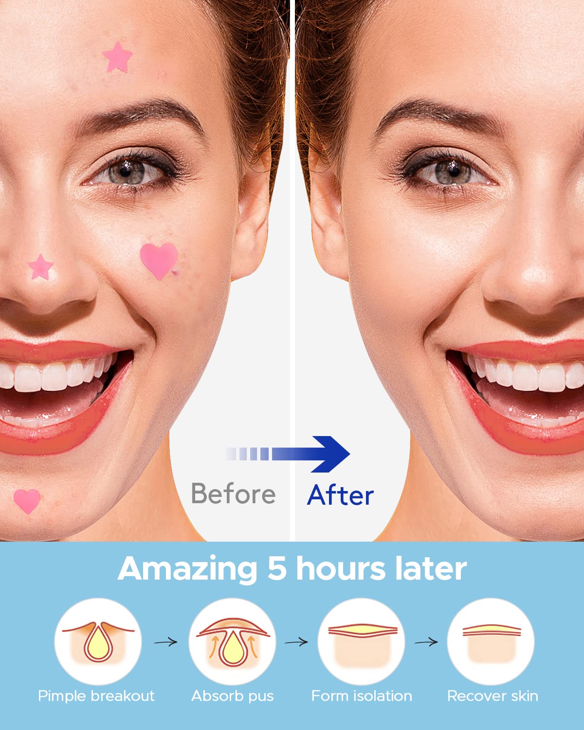 LitBear Acne Patch Pimple Patch, Black Star & Heart Shaped Acne Absorbing Cover Patch, Hydrocolloid Acne Patches For Face Zit Patch Pimple Sticker Acne Dots, Tea Tree Oil + Centella (108 Count)